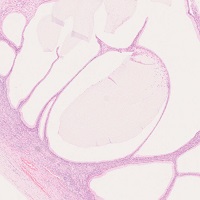 粘液性嚢胞腺腫